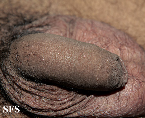 Molluscum contagiosum lesions on penis